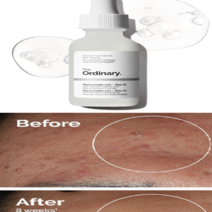 The Ordinary Niacinamide 10% + Zinc 1%, Smoothing Serum for Blemish-Prone Skin
